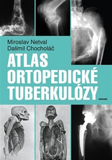 Levně Atlas ortopedické tuberkulózy - Dalimil Chocholáč