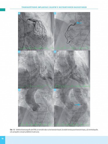 Náhled Transkatétrová implantace chlopní v instruktivních kazuistikách