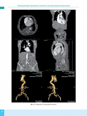 Náhled Transkatétrová implantace chlopní v instruktivních kazuistikách