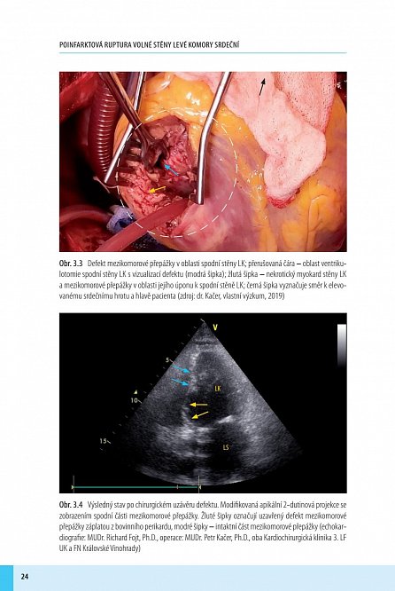 Náhled Poinfarktová ruptura volné stěny levé komory srdeční