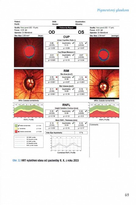 Náhled Sekundární glaukomy - Vybrané kapitoly