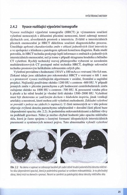 Náhled Intersticiální plicní procesy - Od etiopatogeneze přes radiologický obraz k histopatologické diagnóze
