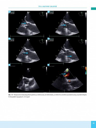 Náhled Transkatétrová implantace chlopní v instruktivních kazuistikách