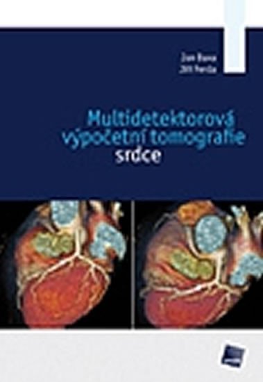Multidetektorová výpočetní tomografie srdce - Jan Baxa